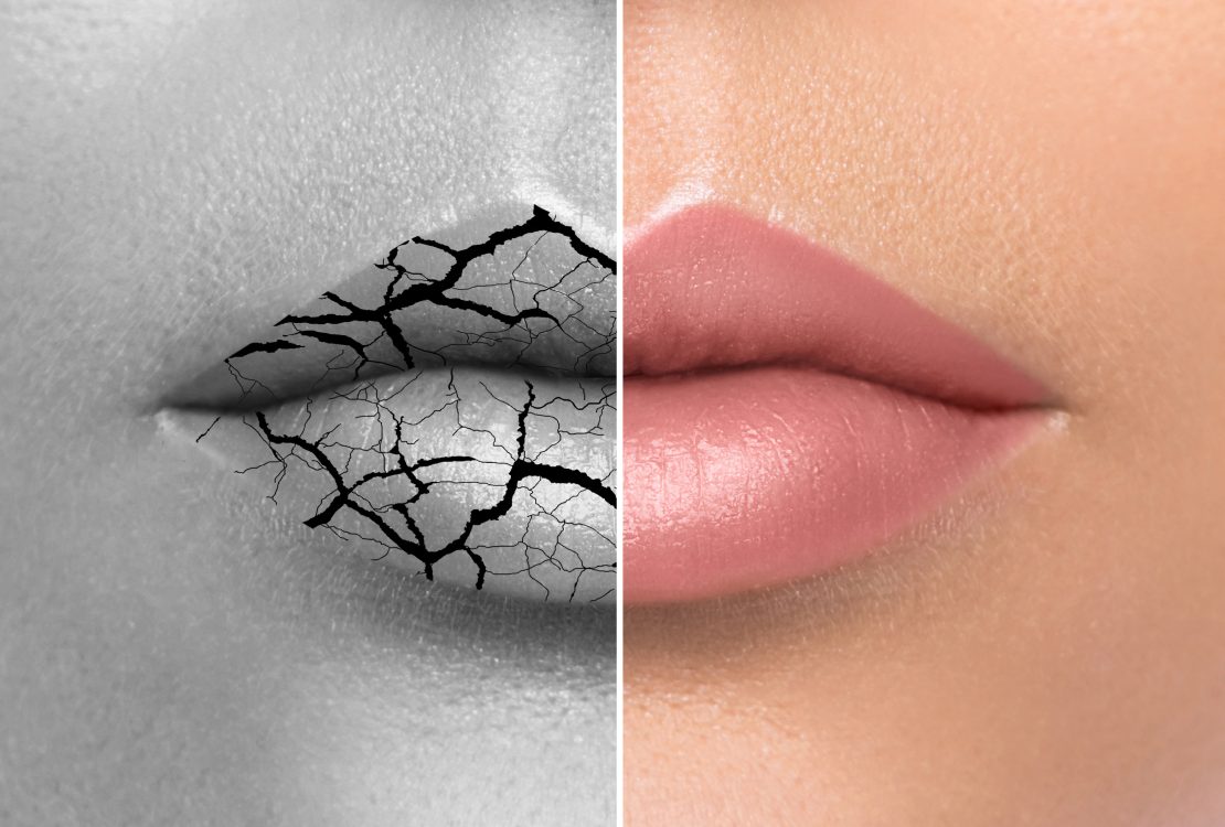 Dealing Chapped Lips