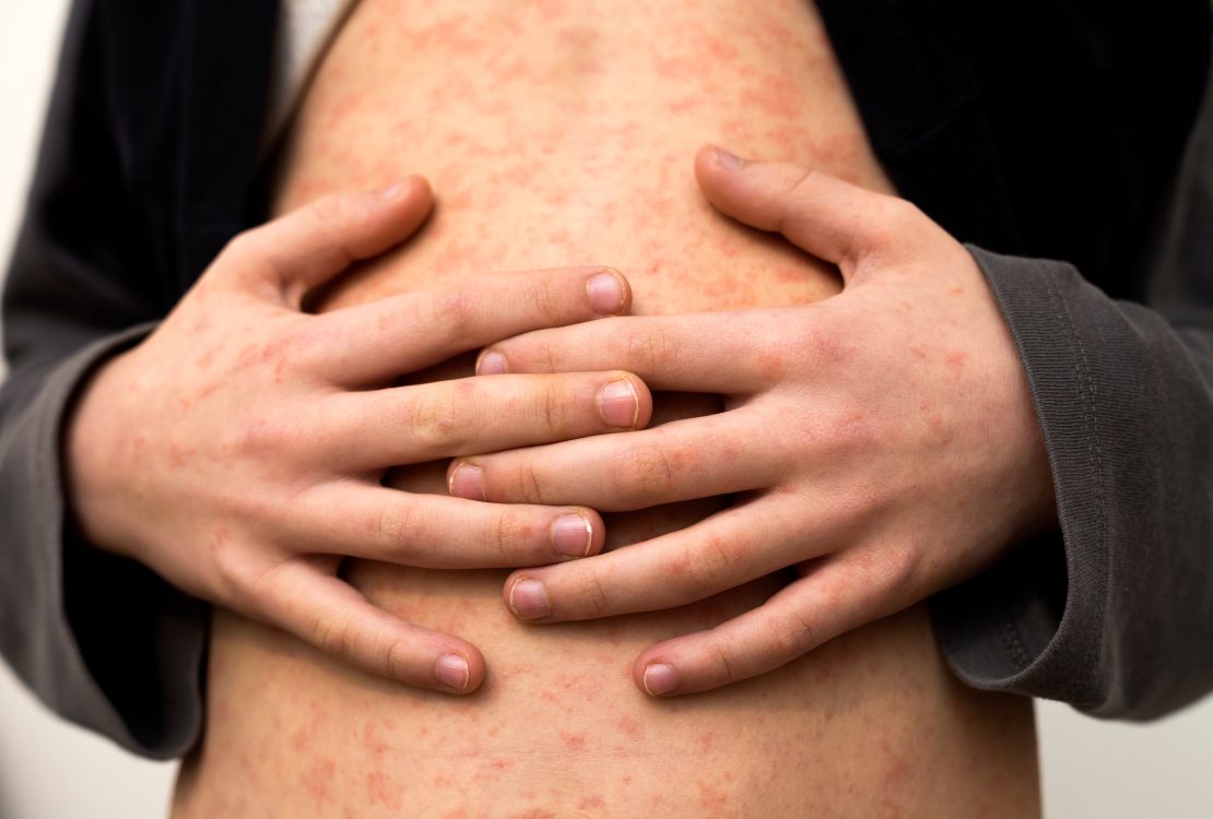 Measles: How Likely You Are To Get It And What Happens If You Do