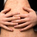 Measles: How Likely You Are To Get It And What Happens If You Do